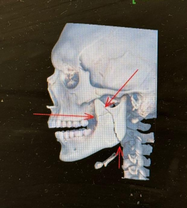 Luca Watson xray